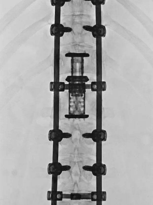 Radiografia de coluna toracolombar com instrumentação por parafusos