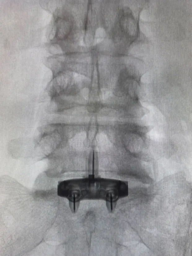 Radiografia anteroposterior da transição lombossacra após estabilização