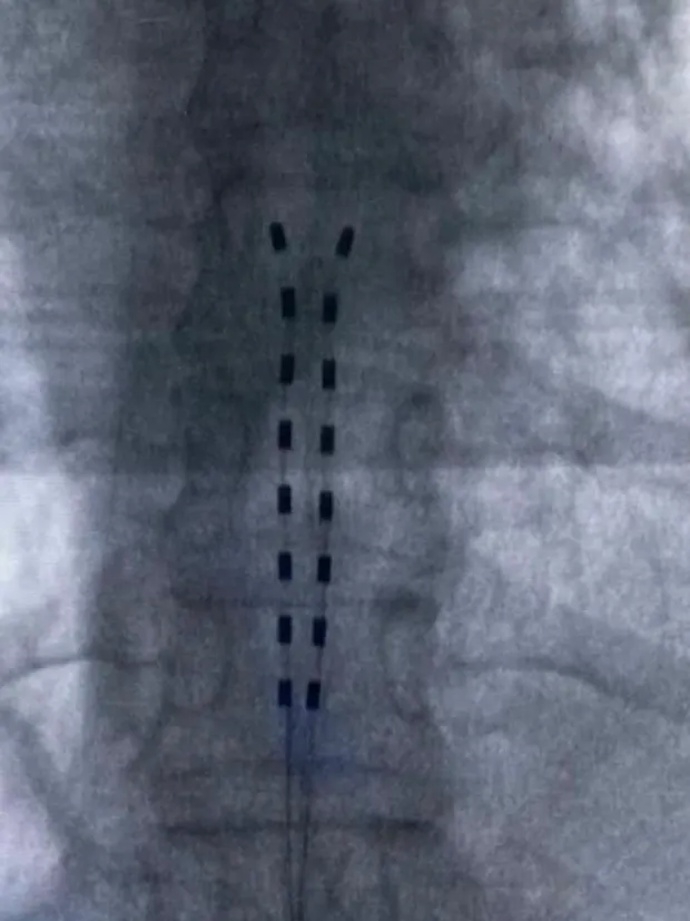 Fluoroscopia intraoperatória com eletrodos posicionados sobre a coluna